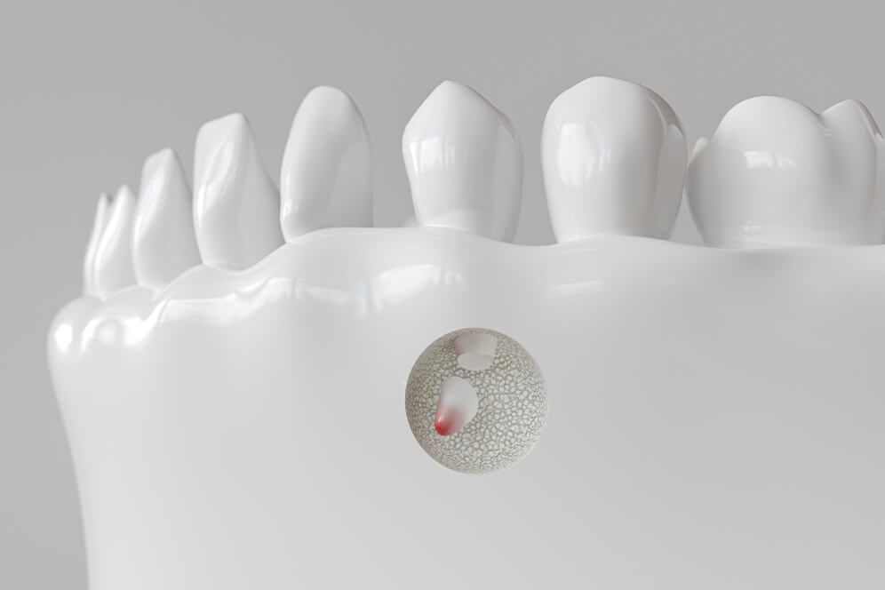 MVZ MediDent 147 GmbH/Endo 147, Berlin - ein künstlich generiertes Bild von einem Unterkiefer. In einem Kreis des Unterkiefers sieht man einen abgebrochenen Zahnwurzel, welcher an seiner Spitze rot ist.